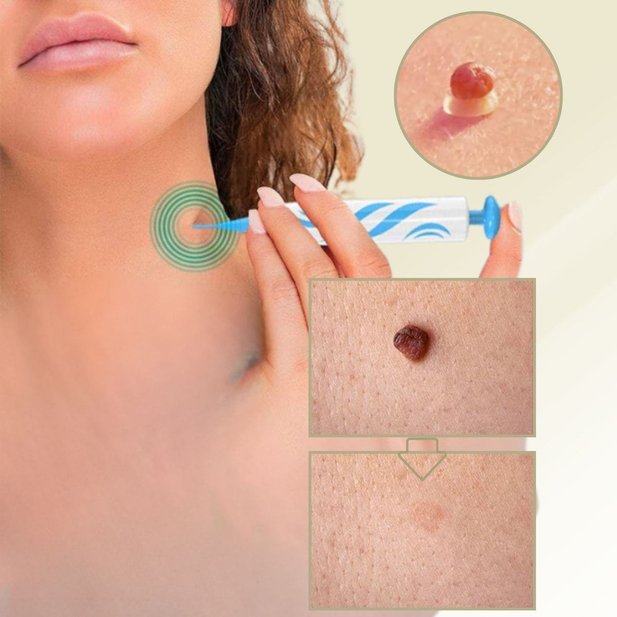 Niropi | DermaLinx Wart Remover | Pain-Free Removal of Warts & Moles | For Home | Without Surgery