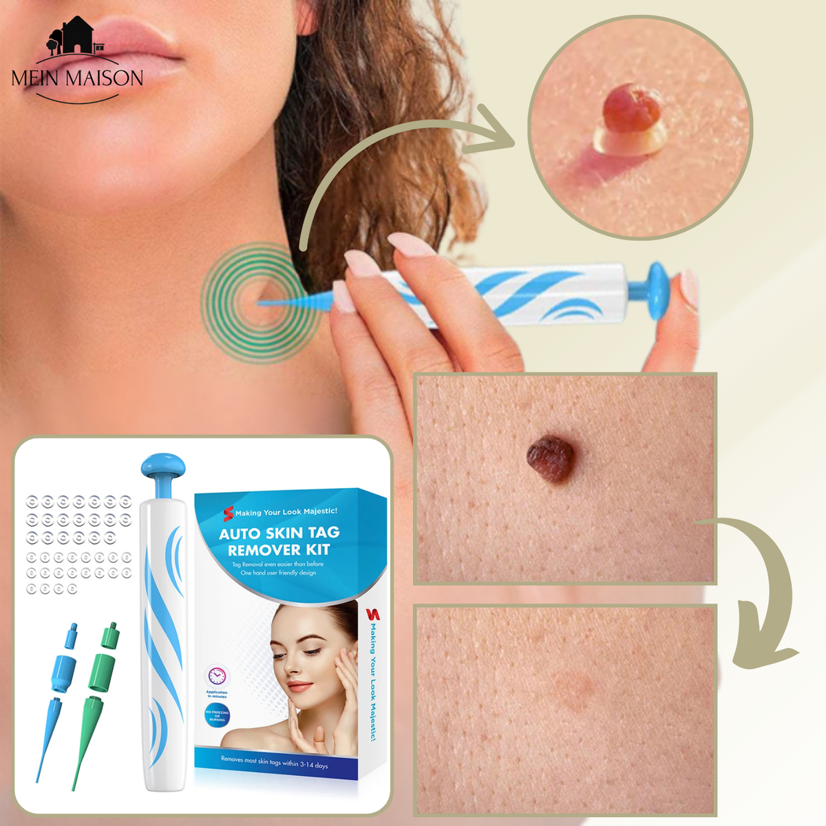Niropi | DermaLinx Wart Remover | Pain-Free Removal of Warts & Moles | For Home | Without Surgery