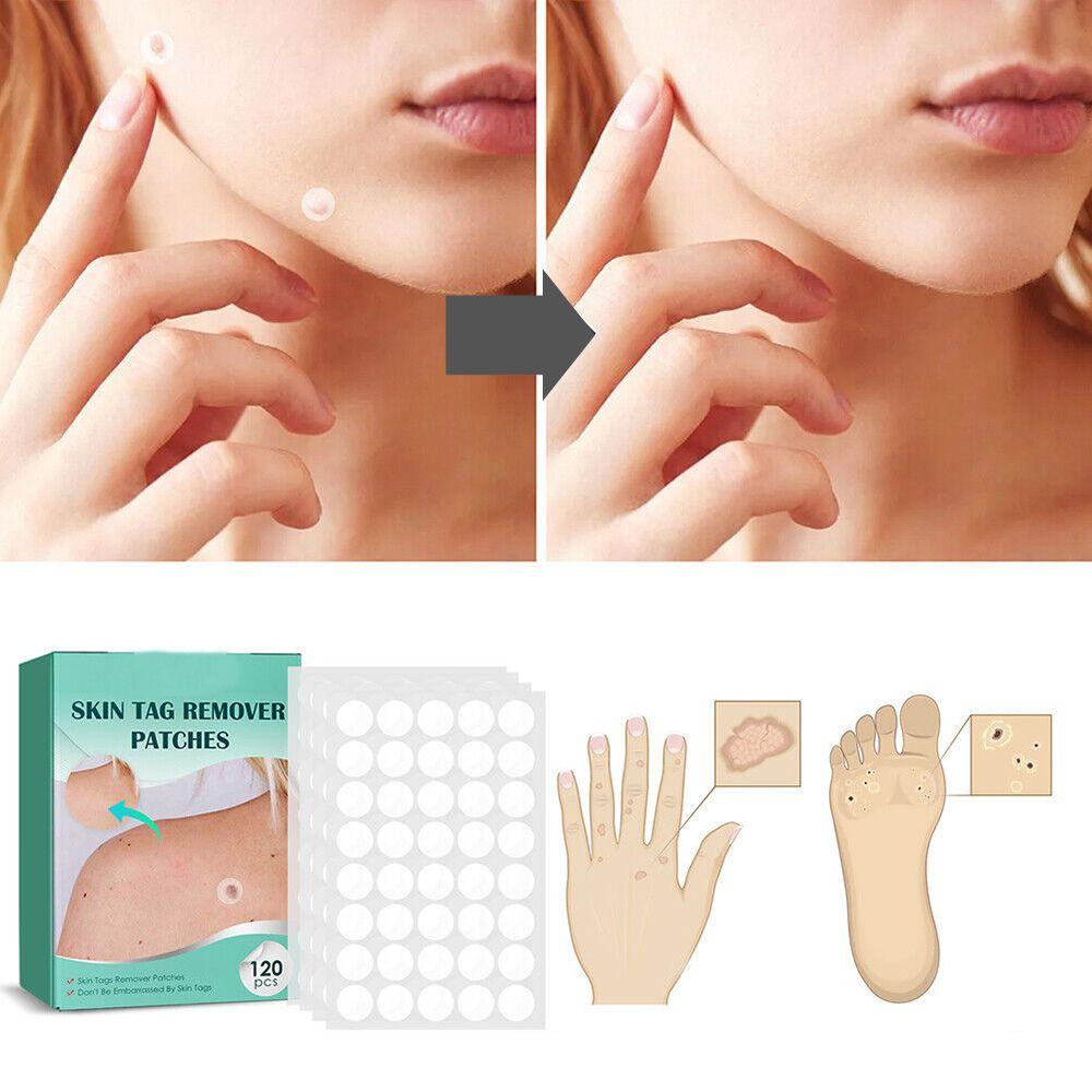 SkinClear - Patch for the removal of spots and warts Niropi