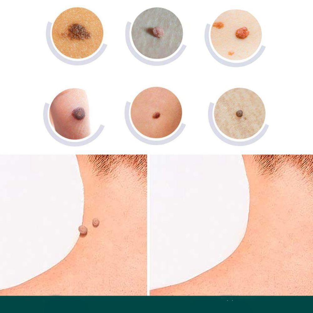 SkinClear - Patch for the removal of spots and warts Niropi