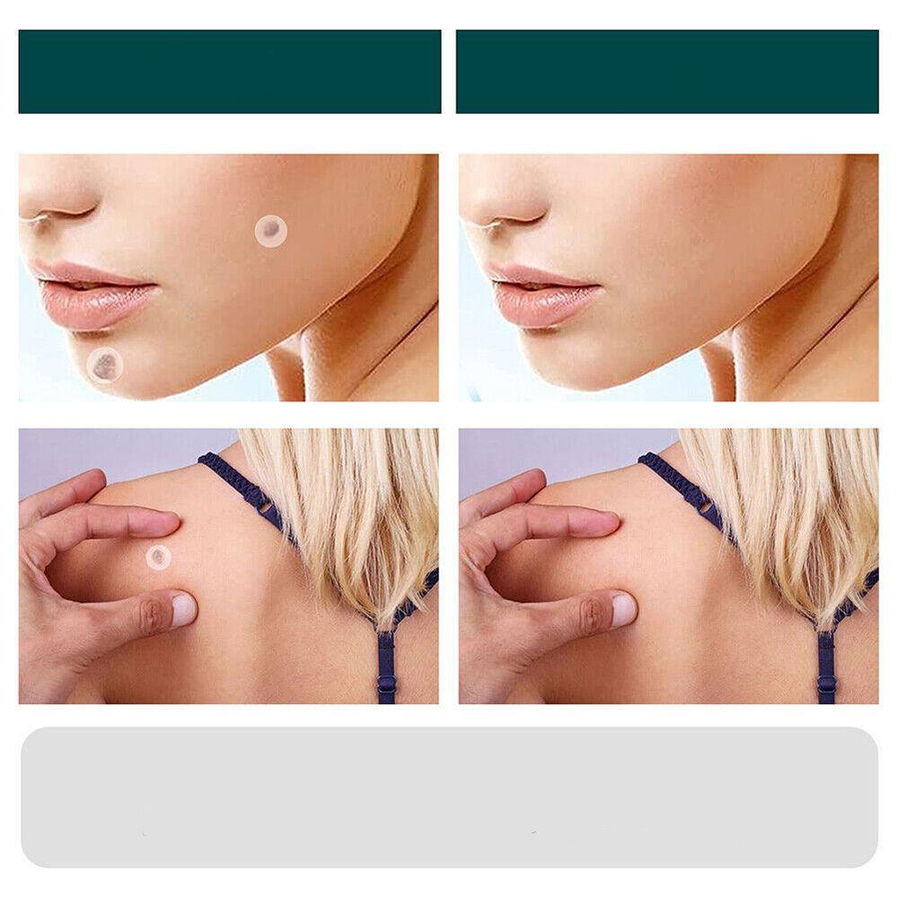 SkinClear - Patch for the removal of spots and warts Niropi